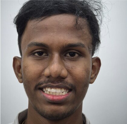 The same smile after treatment, the upper front teeth complete.