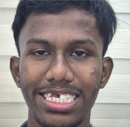 A young man smiling before treatment, with a gap where an upper front tooth is missing.