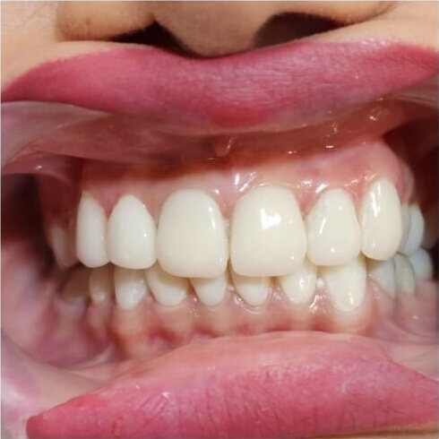 The same teeth from the side after treatment, even and lighter.