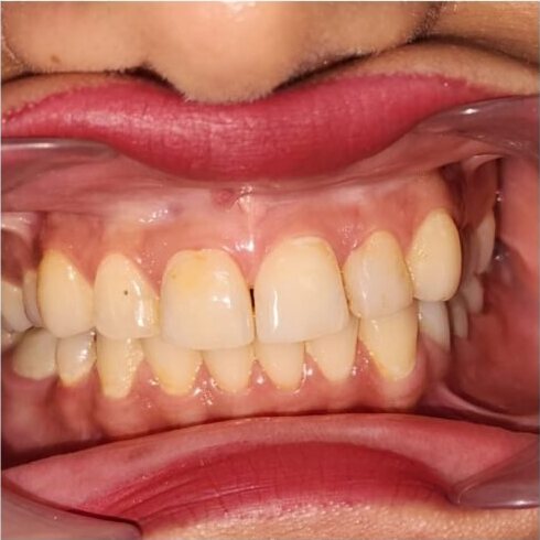 The upper and lower teeth photographed from the side before treatment, worn and discoloured.