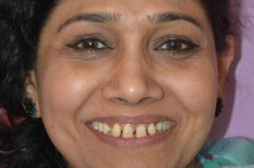 A woman smiling before smile makeover treatment, her upper front teeth uneven and yellowed.