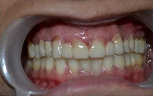 The same teeth after treatment, photographed with the lips held clear.