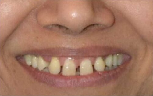 A close view of the upper and lower front teeth in a natural smile before treatment.