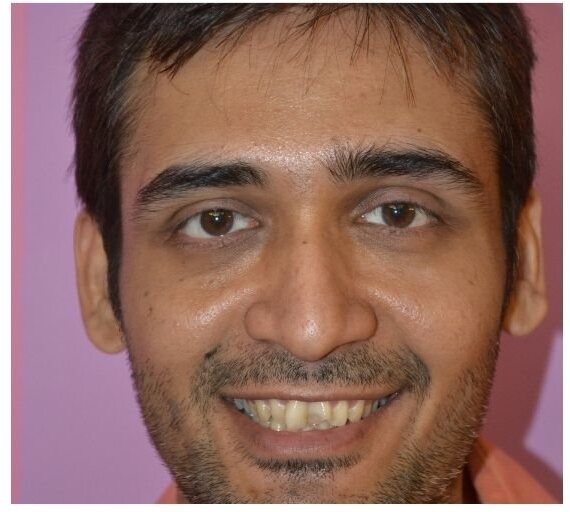 A young man's smile before treatment, his upper front teeth uneven.