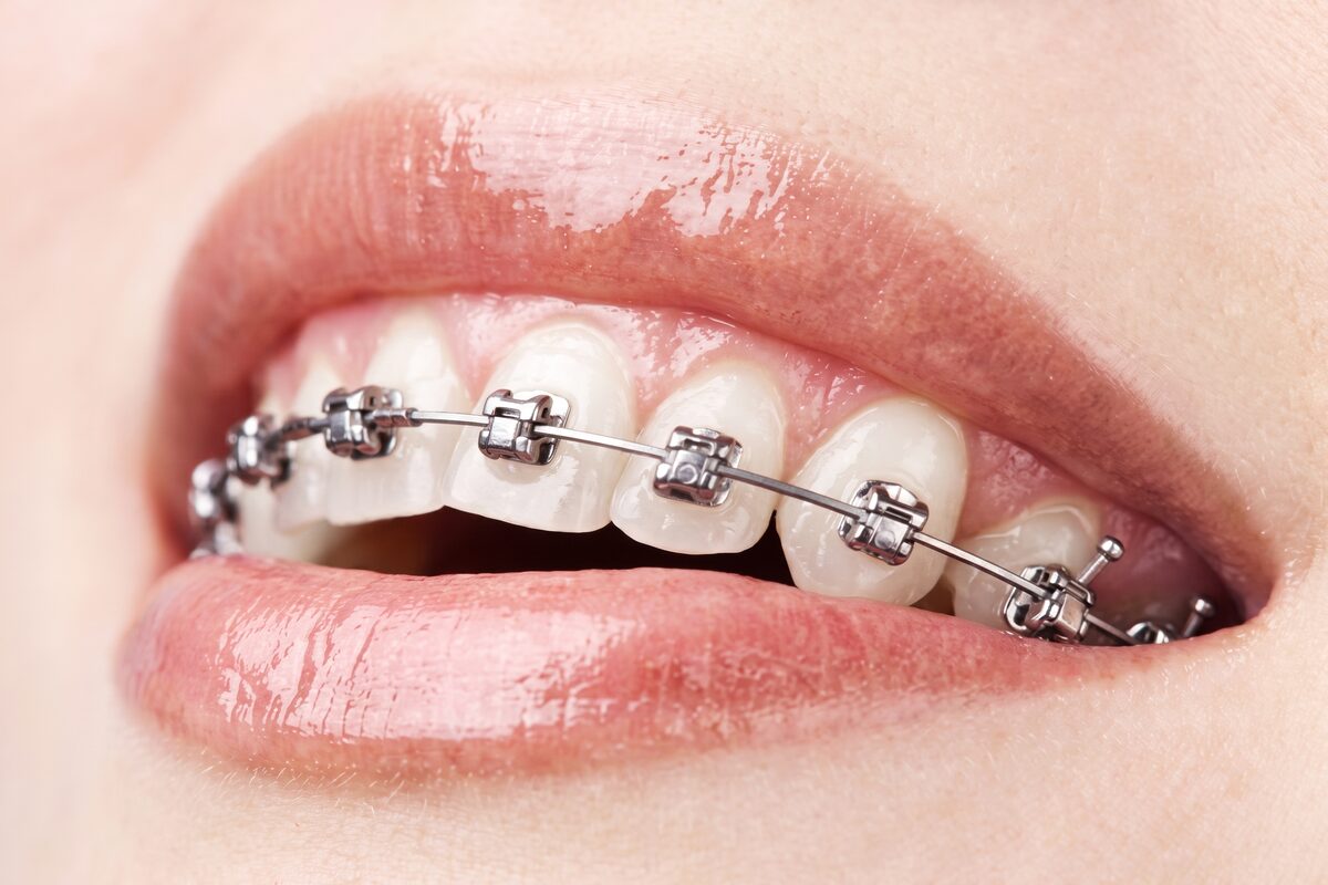 Fixed metal braces on the upper front teeth: small steel brackets bonded to each tooth and joined by a thin archwire.