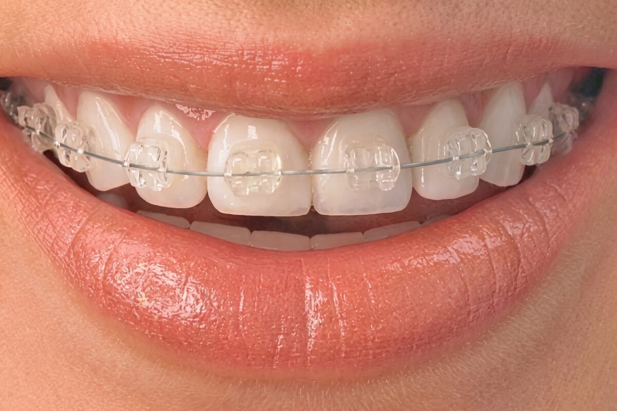 Fixed ceramic braces on the upper front teeth: tooth-coloured brackets joined by a thin archwire.
