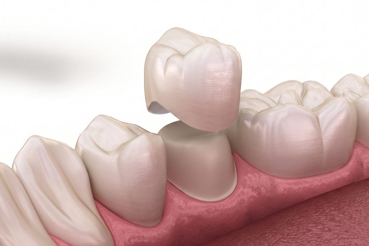 A clinical render of a single dental crown being seated onto a prepared tooth in the lower jaw.