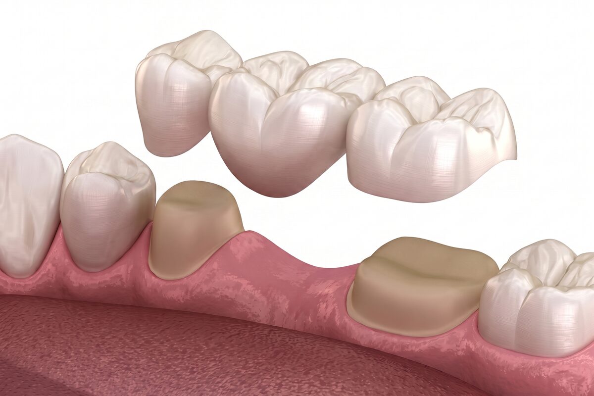 A clinical render of a three-unit dental bridge above the two prepared teeth it will be cemented onto.