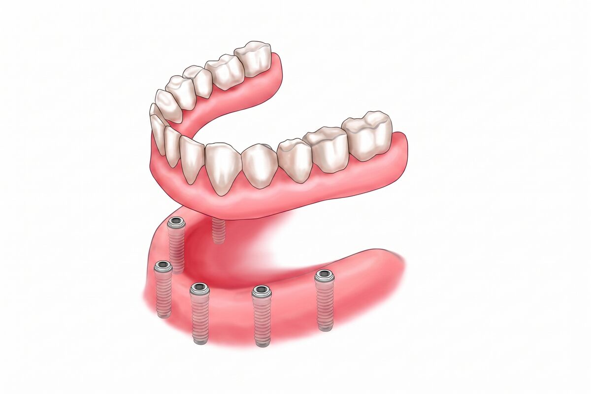A clinical render of a lower denture above the jaw, with implant posts set into the gum to hold it.