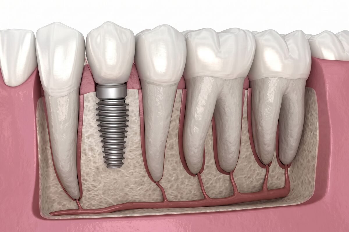A cut-away clinical render of a dental implant post set into the jawbone beside the natural tooth roots.